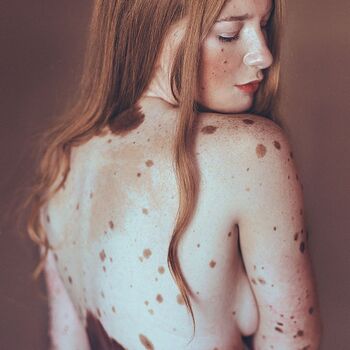 Freckles