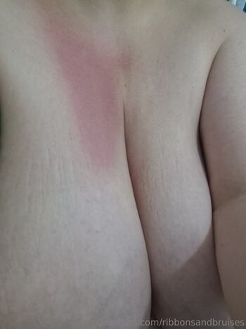 ribbonsandbruises